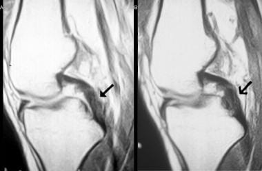 Interstitial tear of the mid and distal PCL. Proto