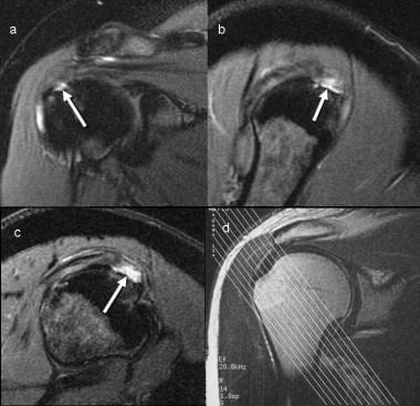 Partial-thickness tear seen better on angled obliq