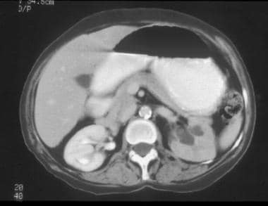 CT of a patient with stage IVB cervical carcinoma 