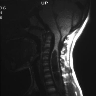 Sagittal T1-weighted magnetic resonance image of t