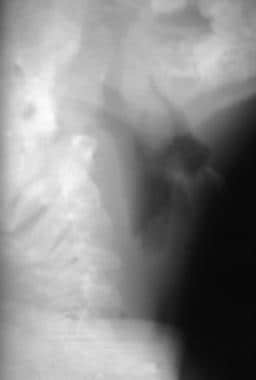 Lateral radiograph in a patient with croup. This i