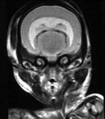 Early fetal magnetic resonance image shows alobar 