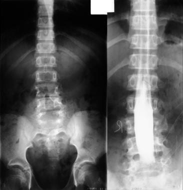 Left, plain radiograph of the lumbar spine shows b