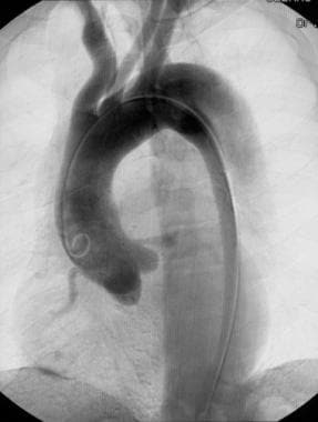 Oblique arteriogram of the thoracic aorta demonstr