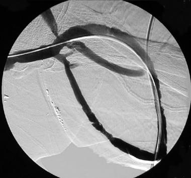 Patent loop of arteriovenous graft after successfu