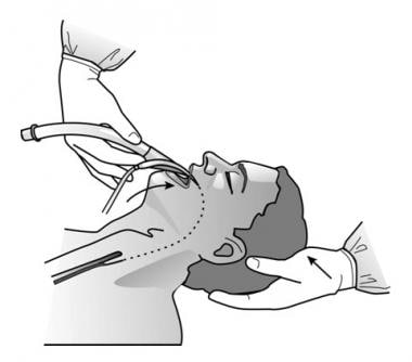 The Role of the LMA as a Ventilating and Intubation Conduit During  Emergency Airway Management