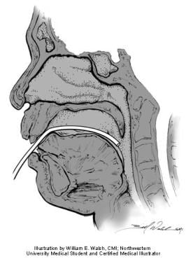 Posterior rhinomanometry. Illustration by William 
