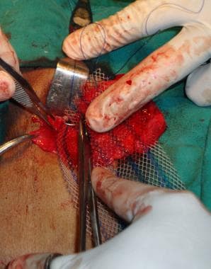 Open inguinal hernia repair. Same suture is utiliz