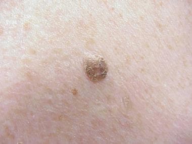 Seborrheic keratosis showing lackluster surface an