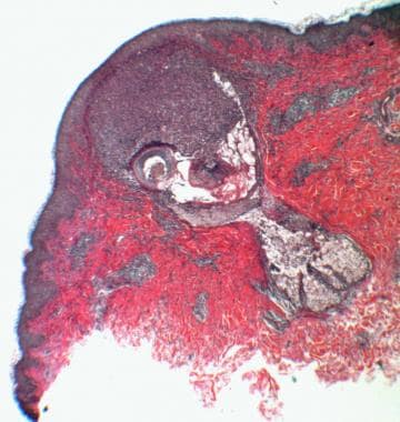 eosinophilic pustular folliculitis histology