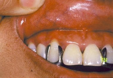 Allergic contact stomatitis on the gingiva in a pa