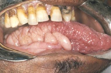 Multiple neurofibromas on the tongue.