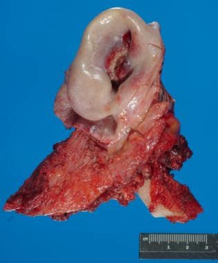 Gross image of an ear resection due to a deeply in