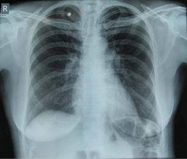 High-altitude pulmonary edema (HAPE). Repeat chest