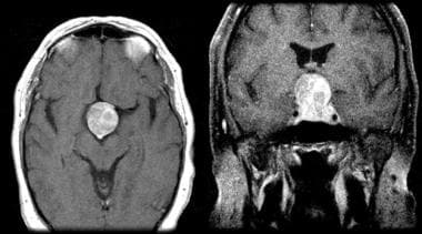 Enhanced axial and coronal T1-weighted MRI of a ty