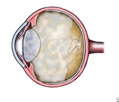 Malignant Glaucoma Background Pathophysiology Epidemiology