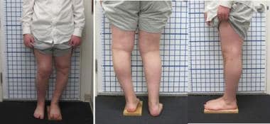 14-year-old boy with unilateral Blount disease dem