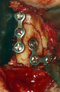 Intraoperative view. Fixation of right mandibular 