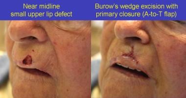 Left: Near midline small upper lip defect. Right: 
