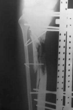 Clinical Case 3. Preoperative radiograph of the tr