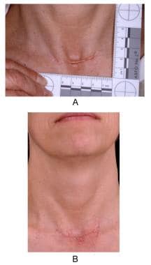 Before and after views of silicone gel treatment in scar management.