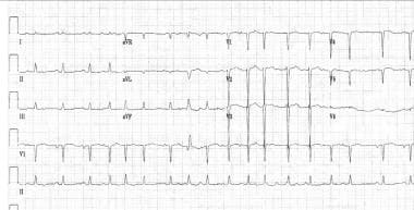 Atrial tachycardia. This electrocardiogram shows m