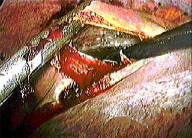 Laparoscopic view of beginning of unroofing of lar
