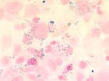 Bone marrow film (1000× magnification) demonstrati