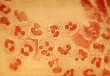 Gram-negative intracellular diplococci. Courtesy P