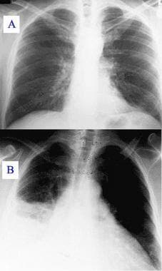 A: Chest radiograph with normal findings. B: Chest