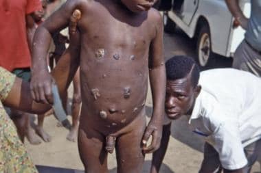 Nigerian boy with ulcerative skin lesions characte