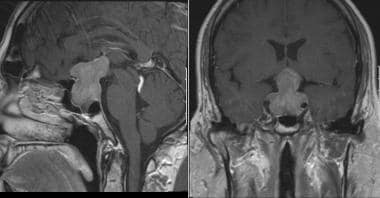 垂体大腺瘤MRI表现。