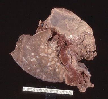 Lung infarction secondary to pulmonary embolism oc