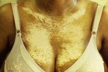 Scleroderma: Anterior chest demonstrating salt-and