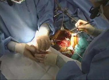 Removal of the native liver. Left behind is the ca