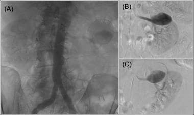 (A) Aortogram with calcified left renal artery ane