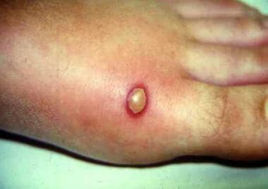 Brown Recluse Bites: Images, Symptoms, Treatment