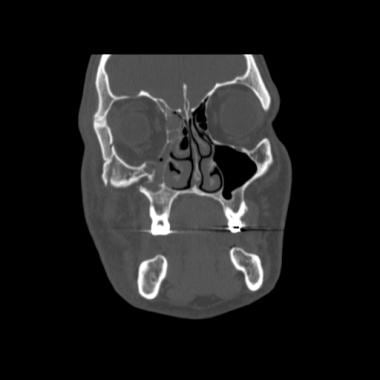 Coronal CT scan demonstrating displaced right zygo