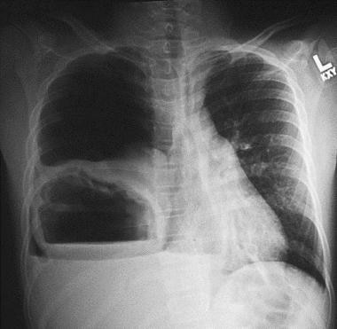 Chest radiograph of a patient with autosomal domin