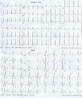 Pediatric Right Bundle Branch Block. These electro