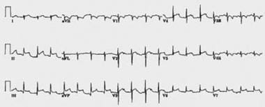 A 12-lead ECG from a patient with bacterial perica