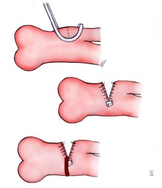 Pulmonary Artery Banding. Incisional pulmonary art