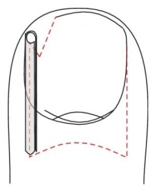 Schematic view illustrating gutter technique. Cour