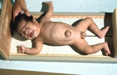 Congenital Hypothyroidism. An infant with cretinis