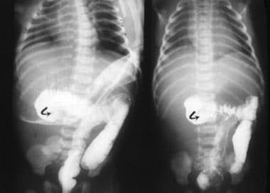 These 2 lower GI series show the cecum (arrows) in