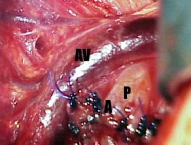 Intraoperative photograph following resection of a