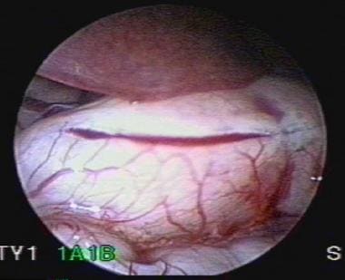 Laparoscopic pyloromyotomy. Pyloric incision.