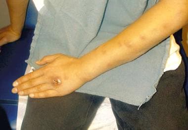 Sporotrichosis with cutaneous necrosis and lymphan