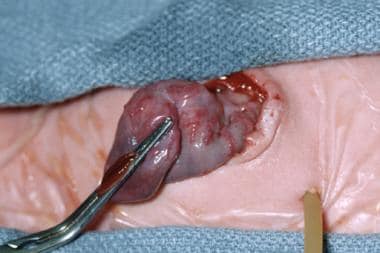 Pediatric omphalocele and gastroschisis (abdominal