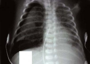 This radiograph shows pneumothorax and pulmonary i